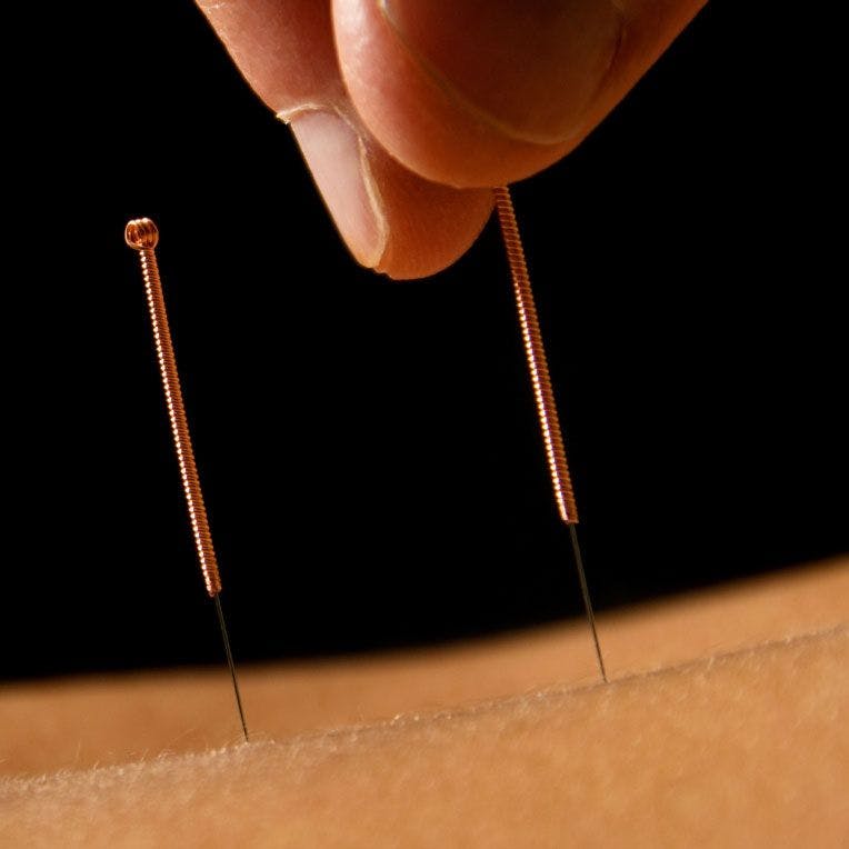 Acupuncture Could Cool Hot Flashes in Breast Cancer Survivors