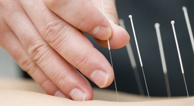 Acupuncture Reduces AI-Associated Joint Pain in Women with Breast Cancer