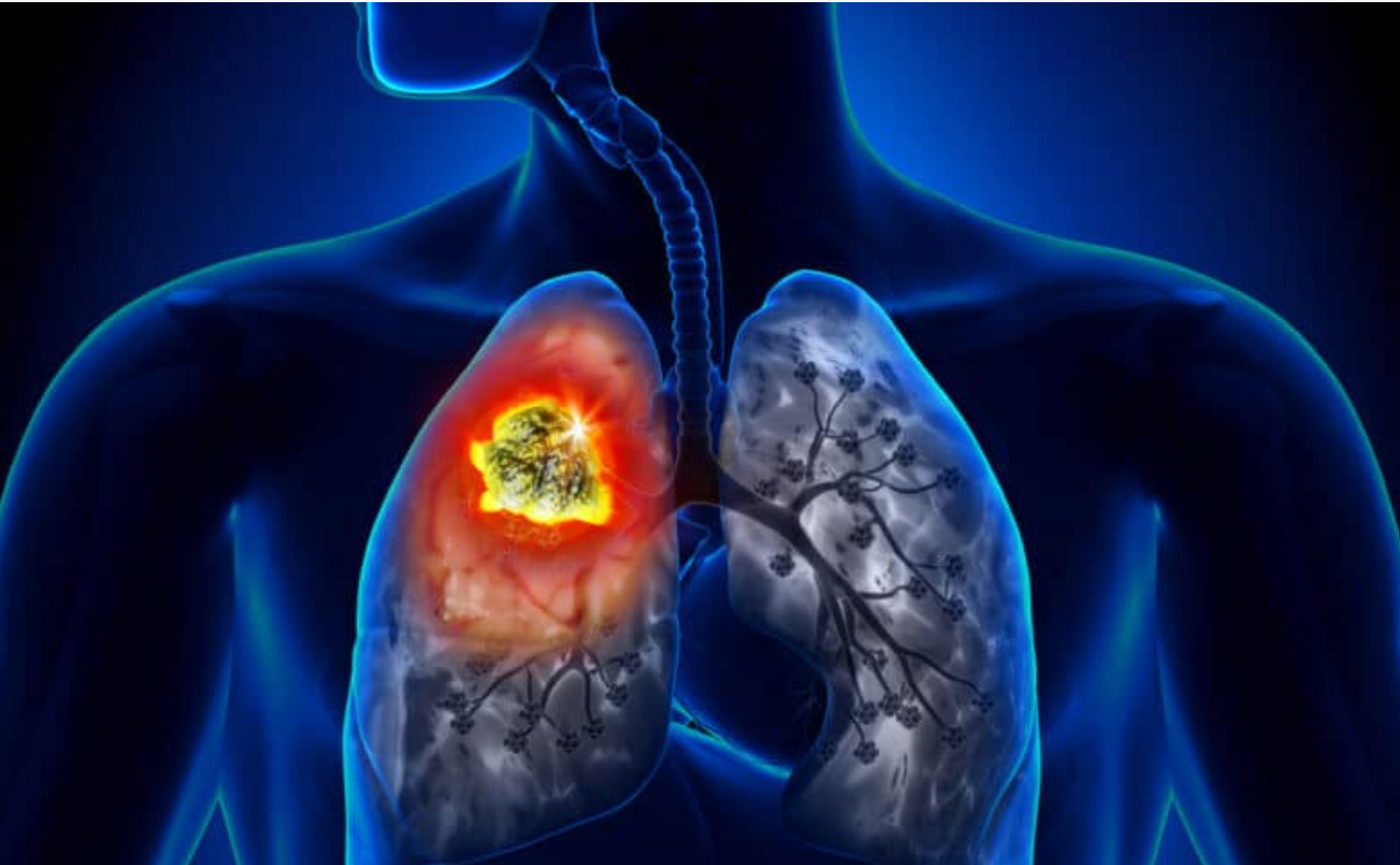 image of NSCLC