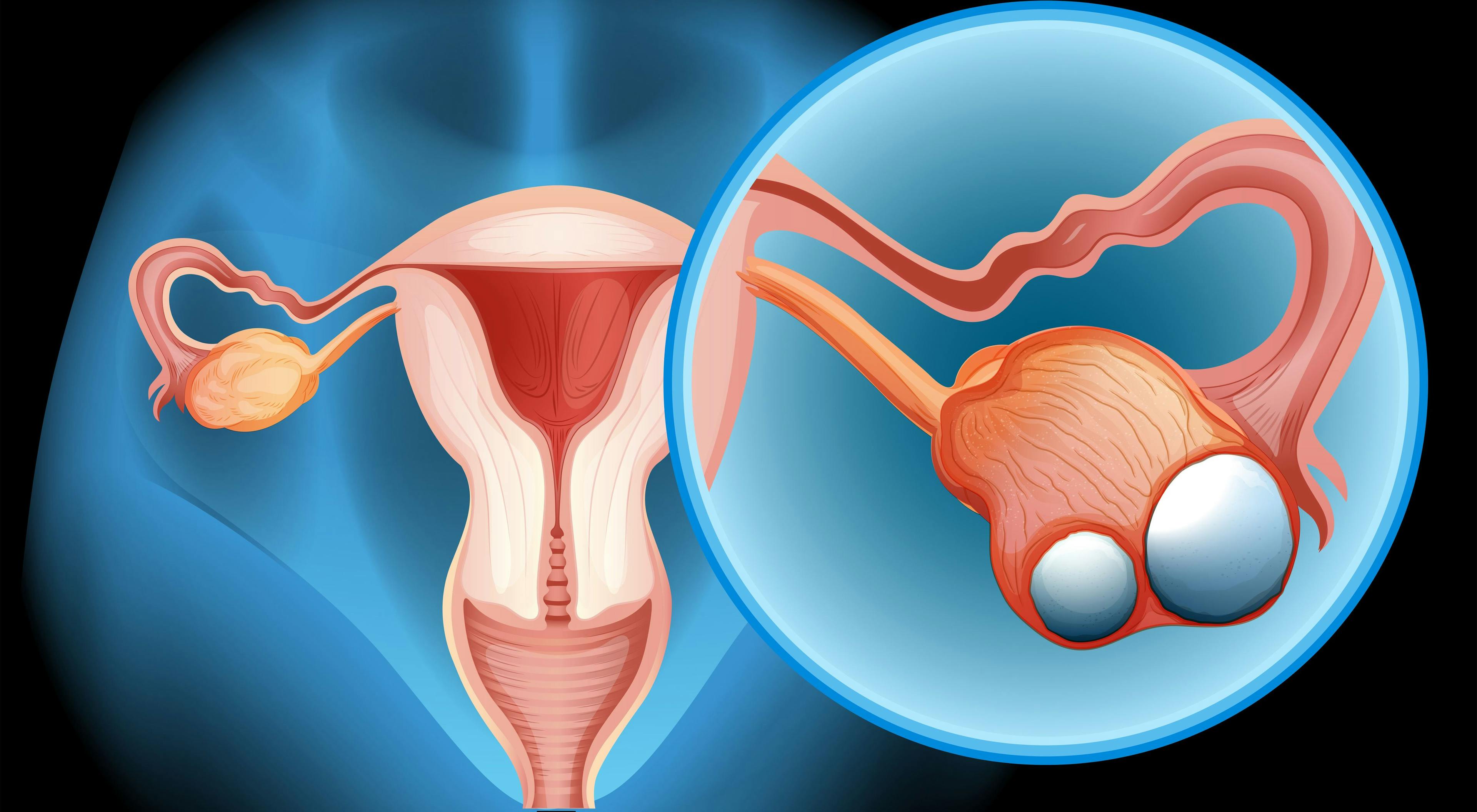 Maintenance Lynparza Improves PFS for Ovarian Cancer
