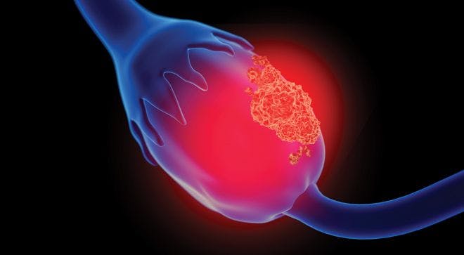 Addition of PARP Inhibitor to Maintenance Therapy May Improve Survival in Ovarian Cancer