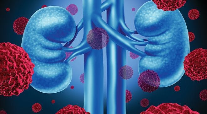 Survival Rates in Renal Cell Carcinoma Vary for African American Patients