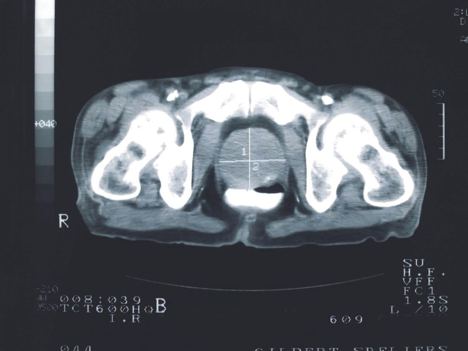 prostate cancer scan