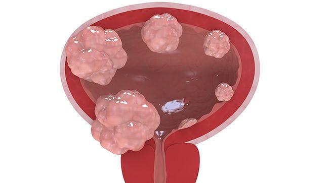 Combination Immunotherapy Shows Promise for Bladder Cancer