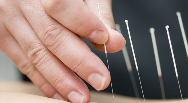Acupuncture Reduces Cancer Pain and Painkiller Use, Study Finds