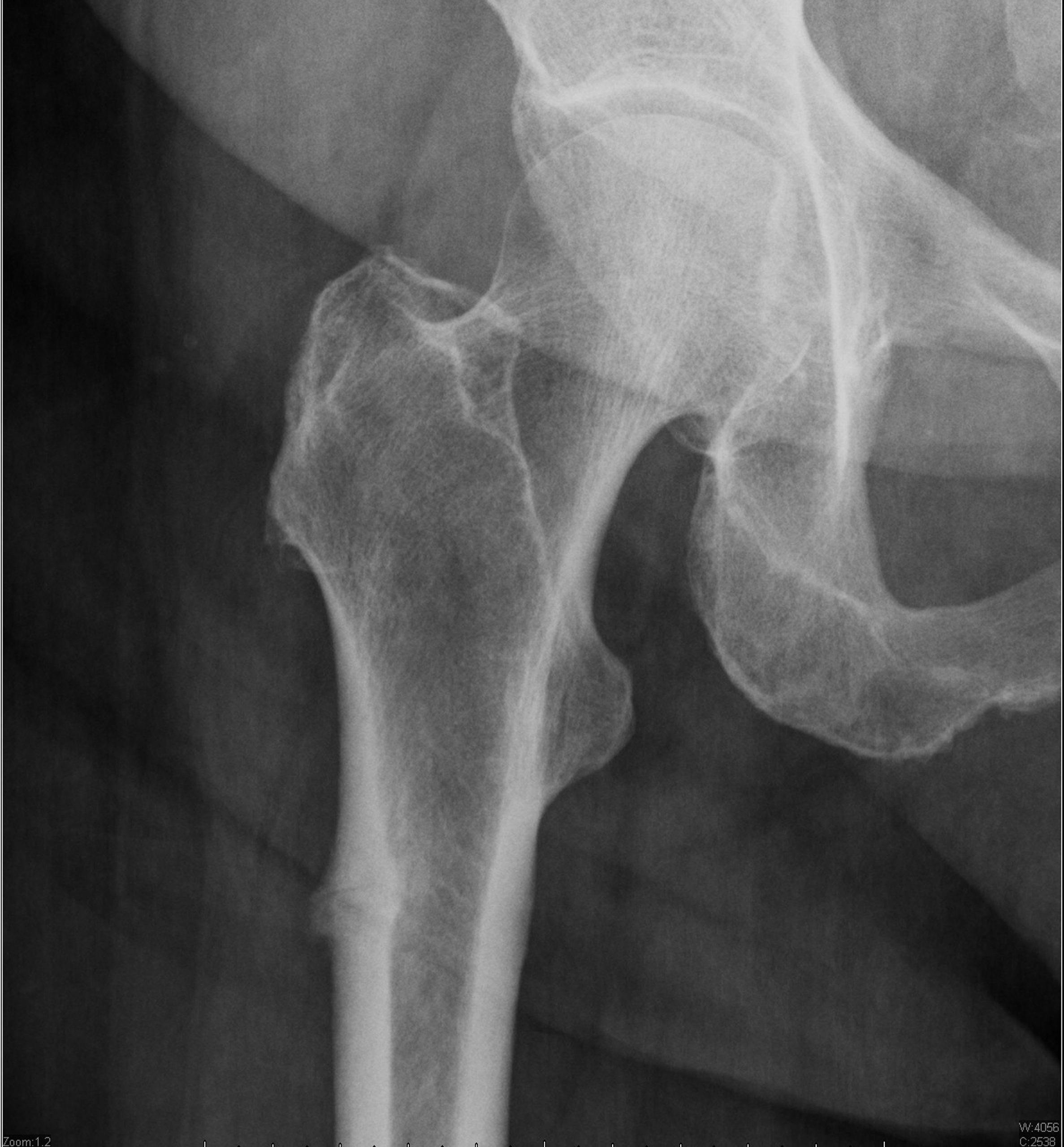 X-ray of a fractured pelvis