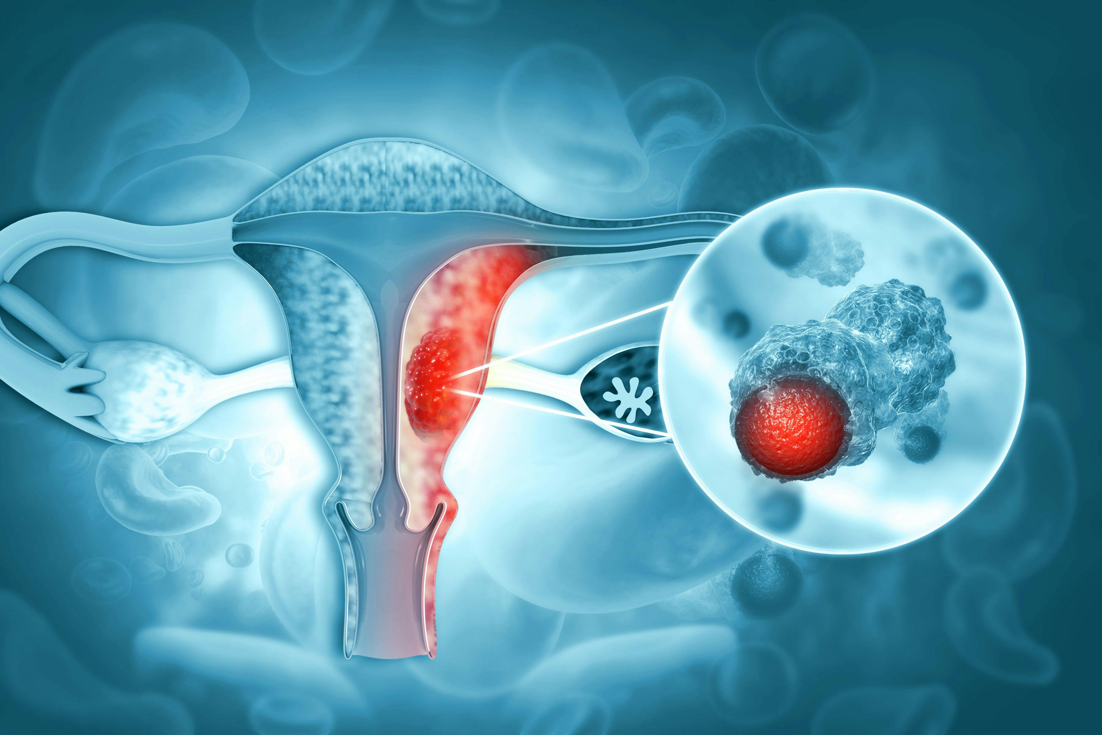 An image of a female reproductive system with a tumor representing endometrial cancer.