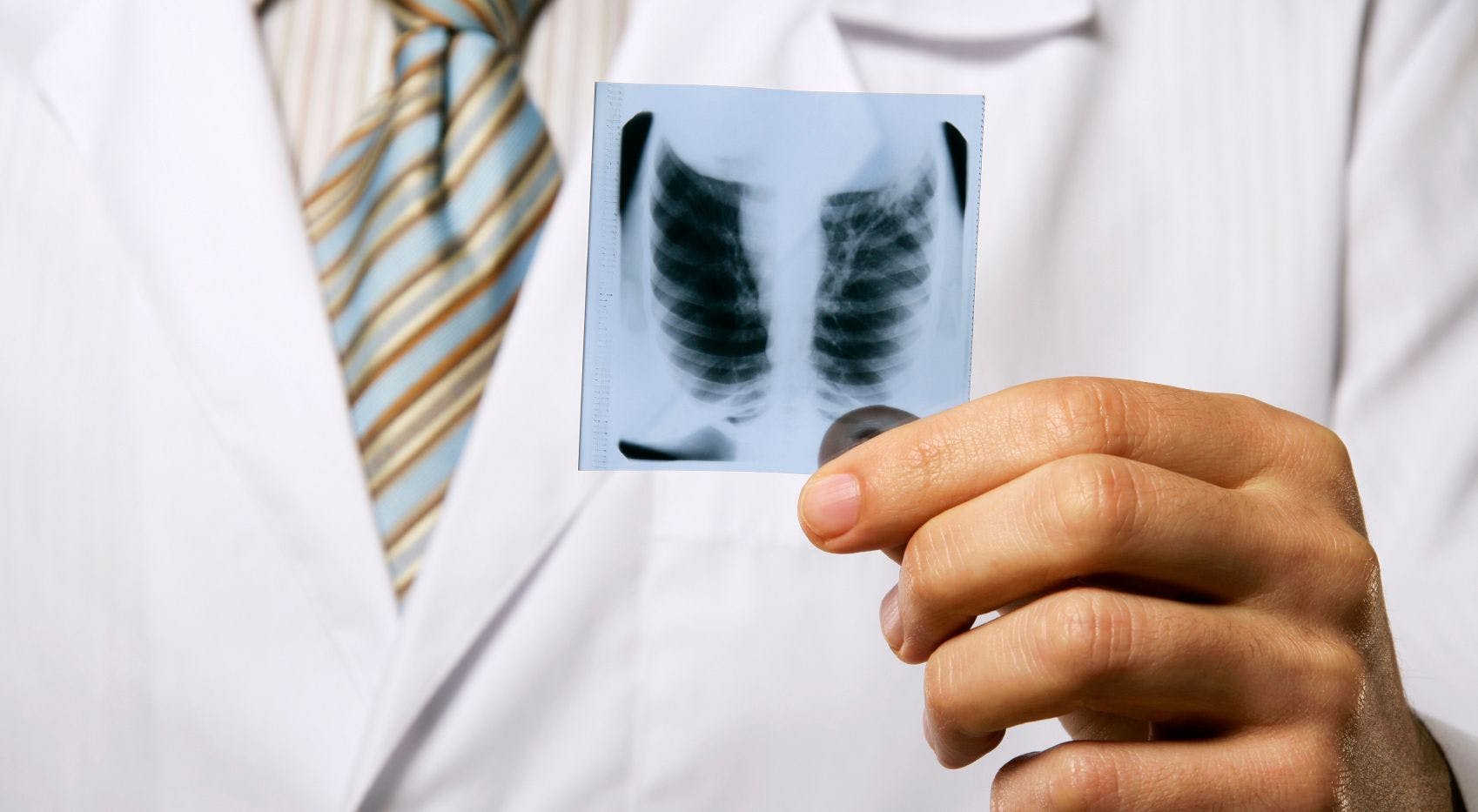 Four-Drug Combination Improves NSCLC Outcomes