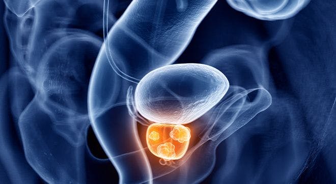 image of prostate cancer scan