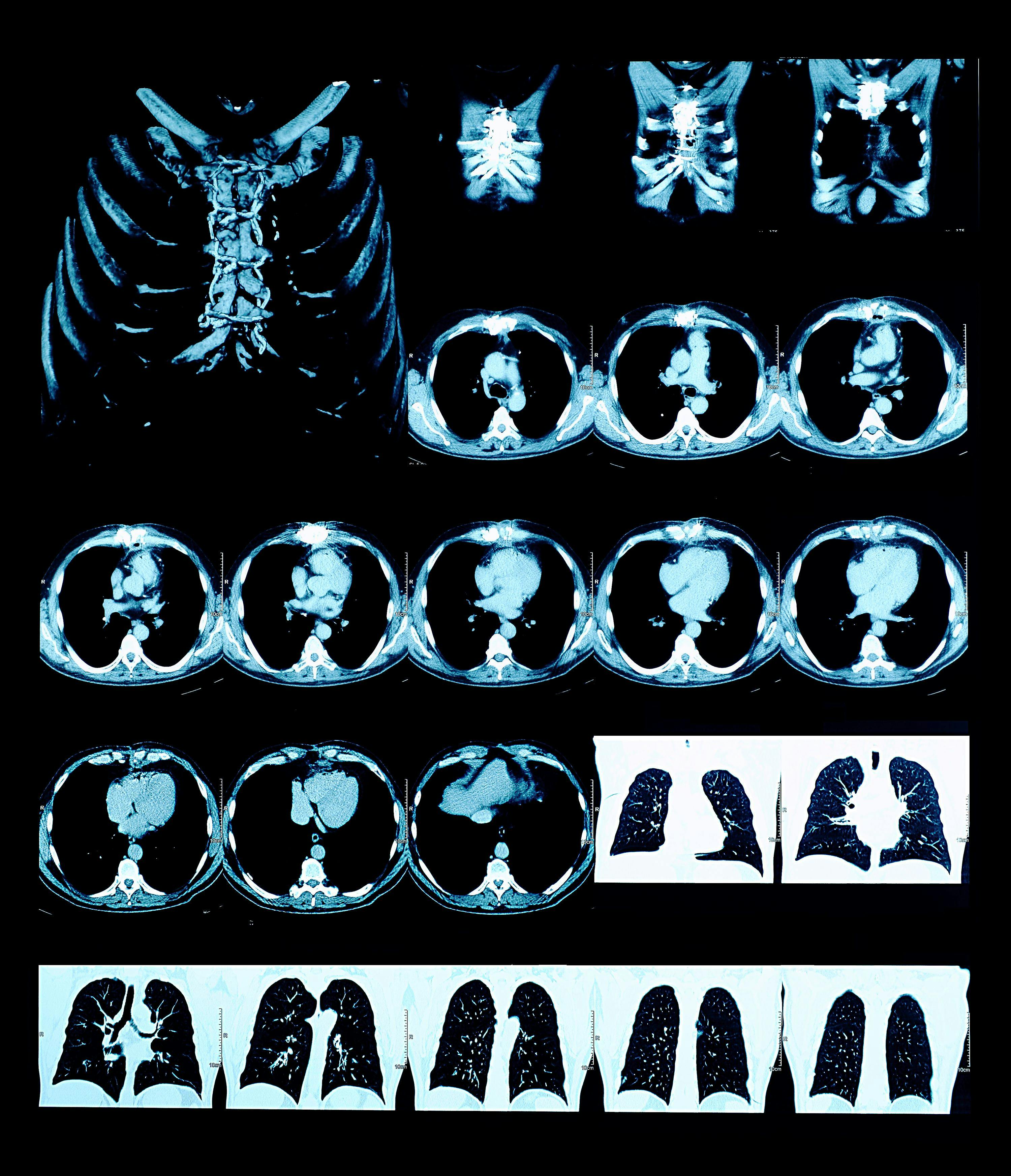 CT scans of the lungs