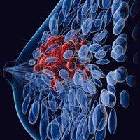 breast cancer image