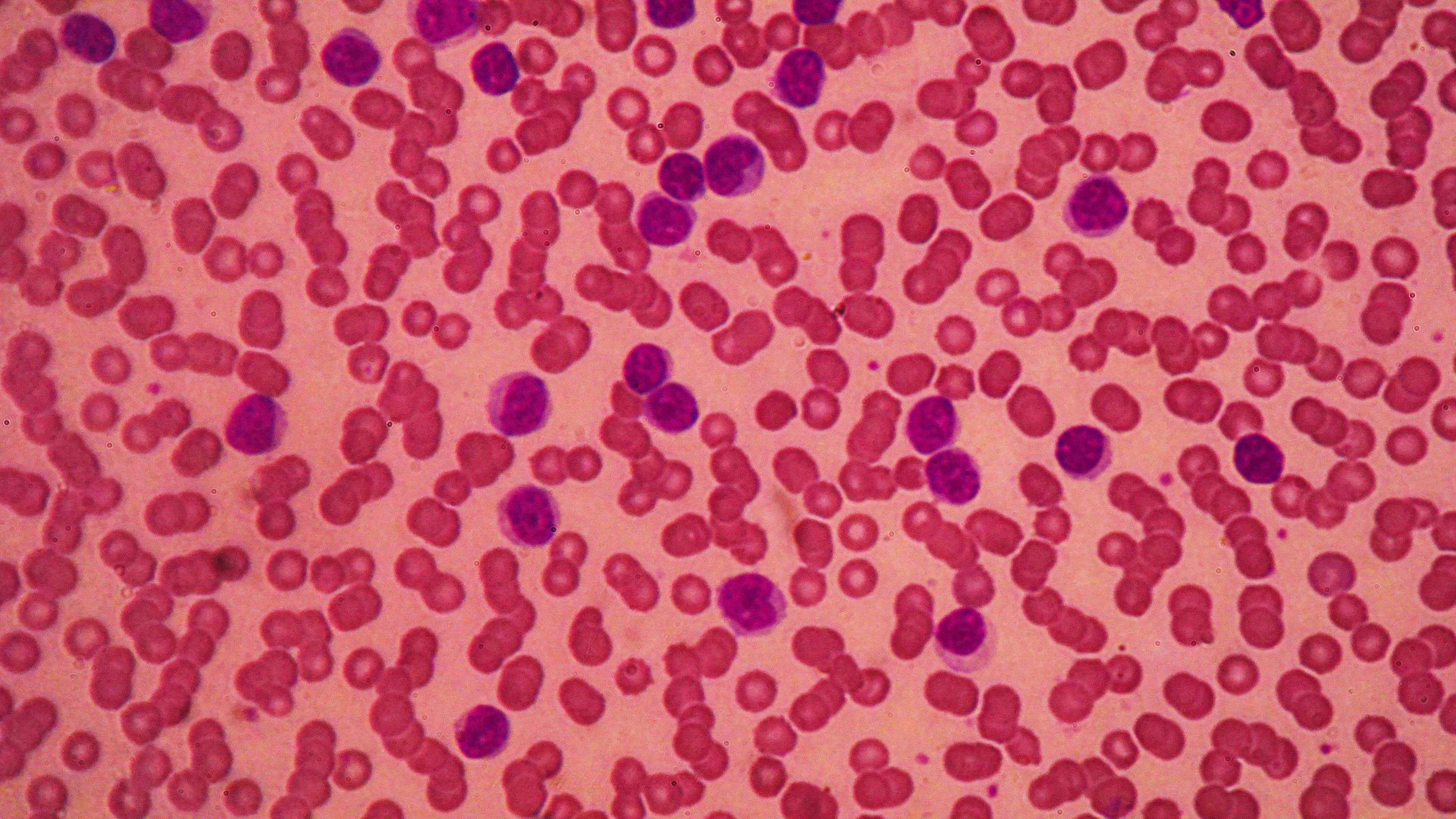 image of CLL cells