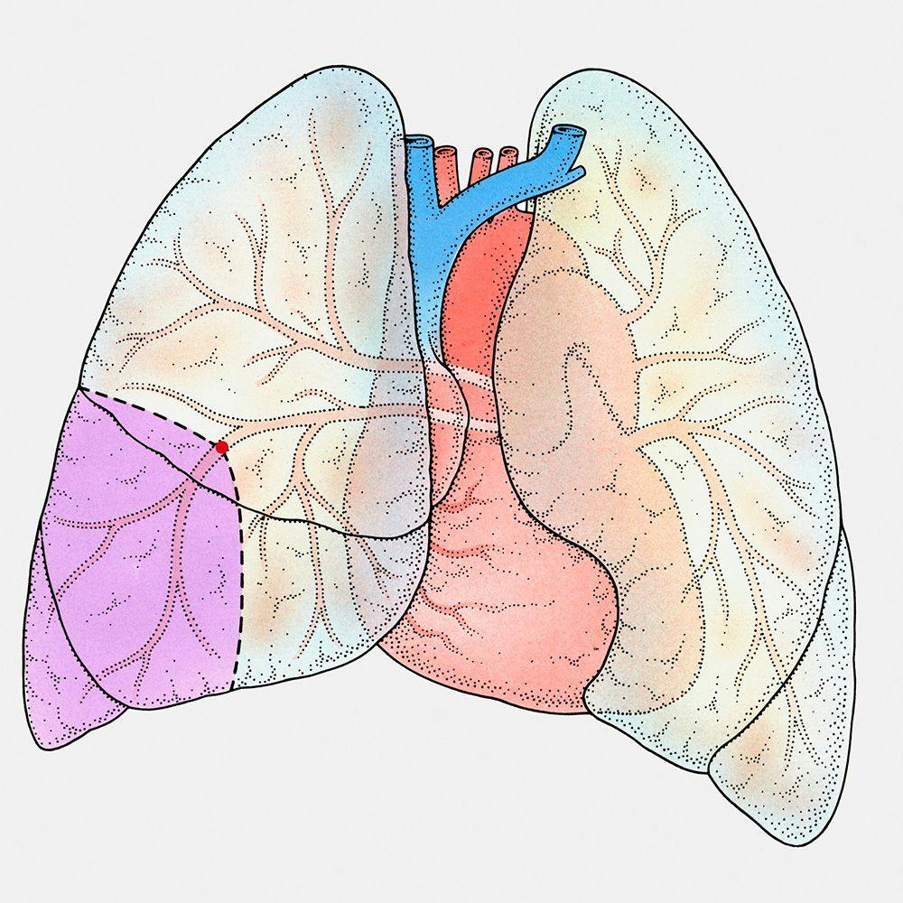 New Trial Could Change Treatment of Lung Neuroendocrine Tumors