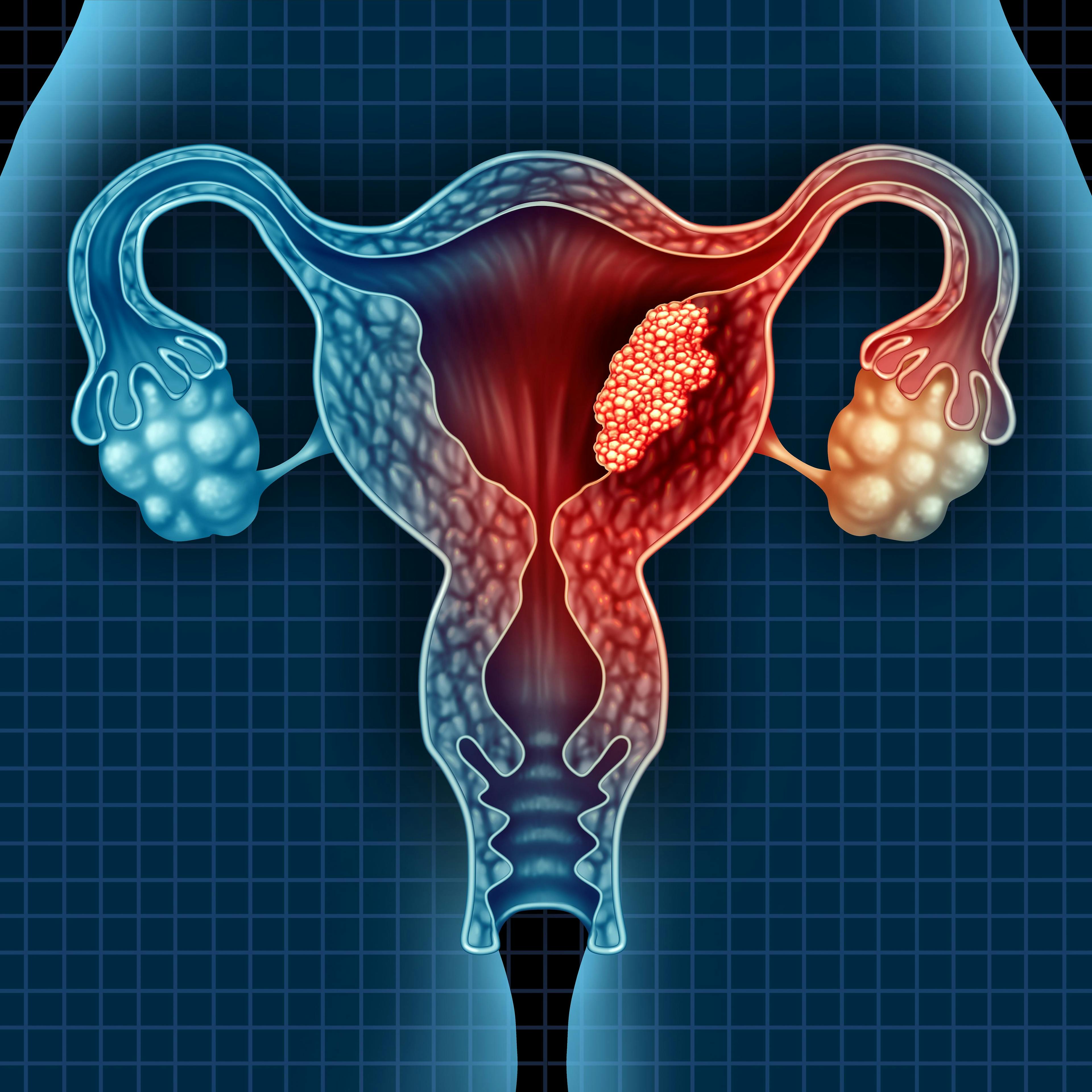 Lenvima Plus Keytruda Bests Chemotherapy for Advanced Endometrial Cancer