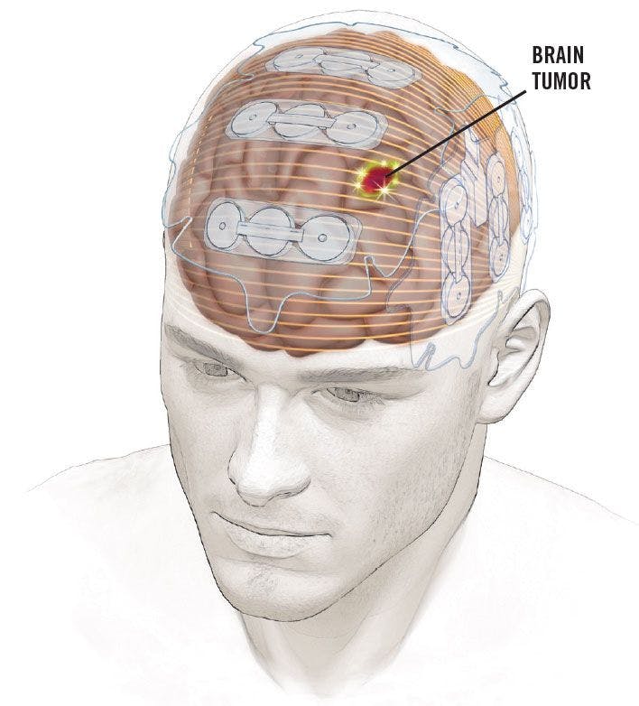 Optune is a device worn on the head that delivers low-intensity electrical fields, known as tumor-treating fields, directly to brain tumors.