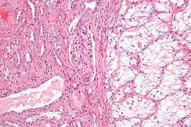 renal cell carcinoma image