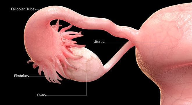 Fallopian Tube Removal May Help Prevent Most Common Ovarian Cancer 