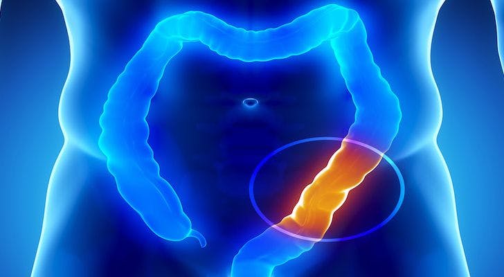 Circulating tumor DNA-based minimal residual disease lent insight into which patients with stage 2/3 colorectal cancer may be at higher risk for recurrence and which could benefit from postsurgical chemotherapy. 
