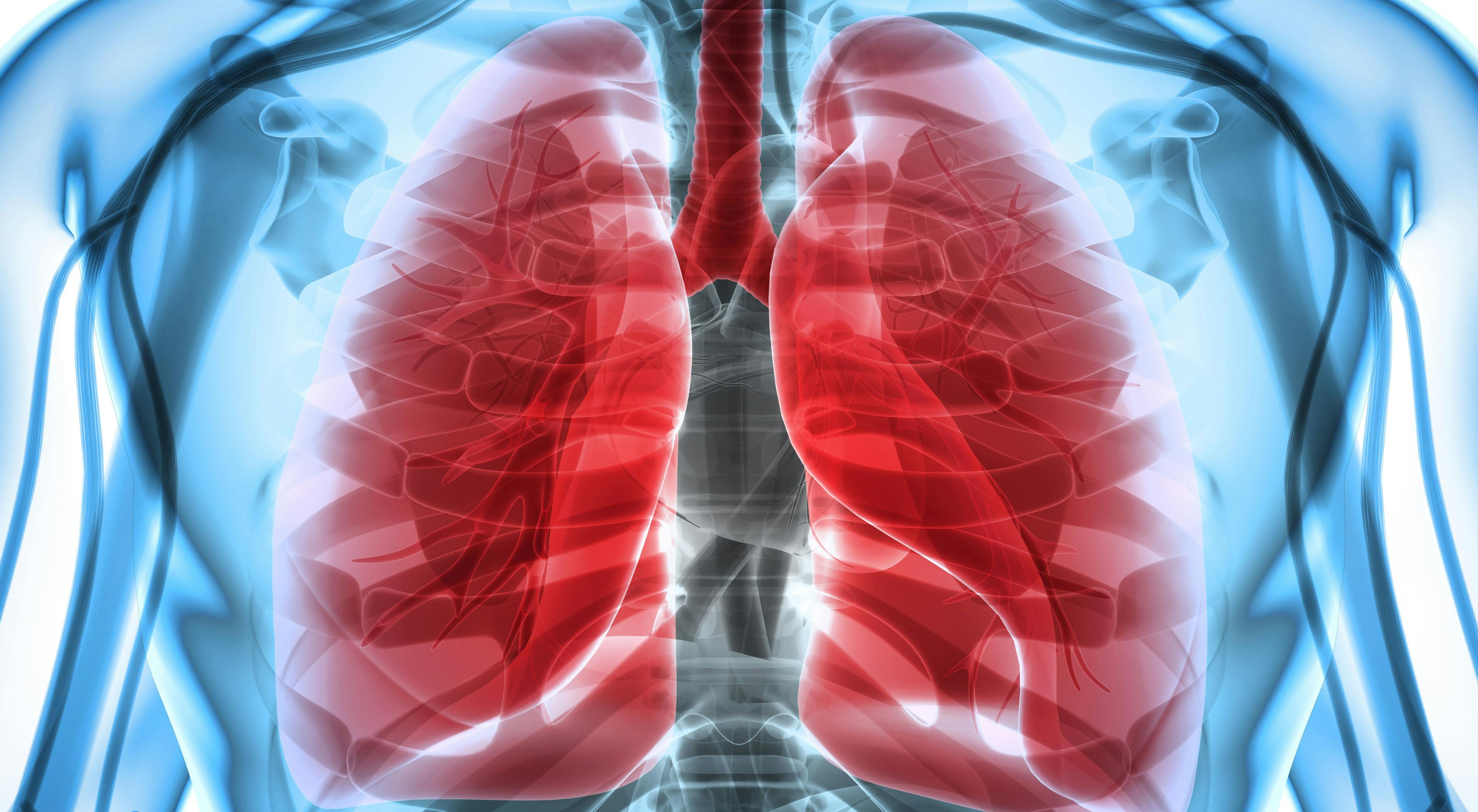 Immunotherapy Provides Long-Awaited Progress in Small Cell Lung Cancer