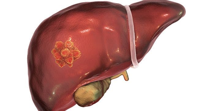 Cabometyx-Tecentriq Combo Bests Nexavar in Controlling Disease, Limiting Progression in Patients With Advanced Liver Cancer