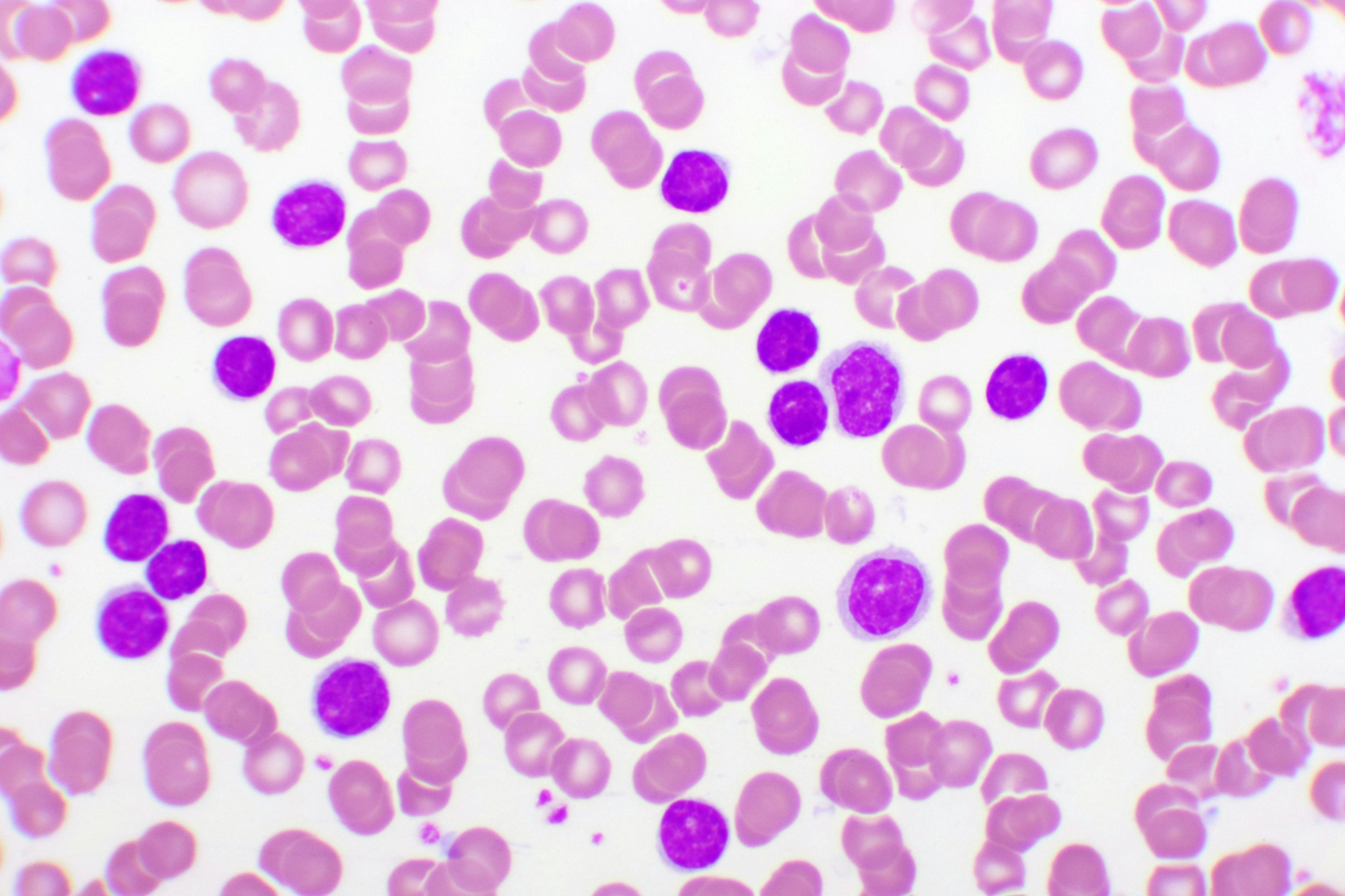 leukemia cells under a microscope