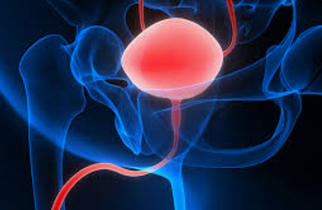 Surgery or Radiotherapy May Confer Similar Survival Rates in Bladder Cancer Subtype 