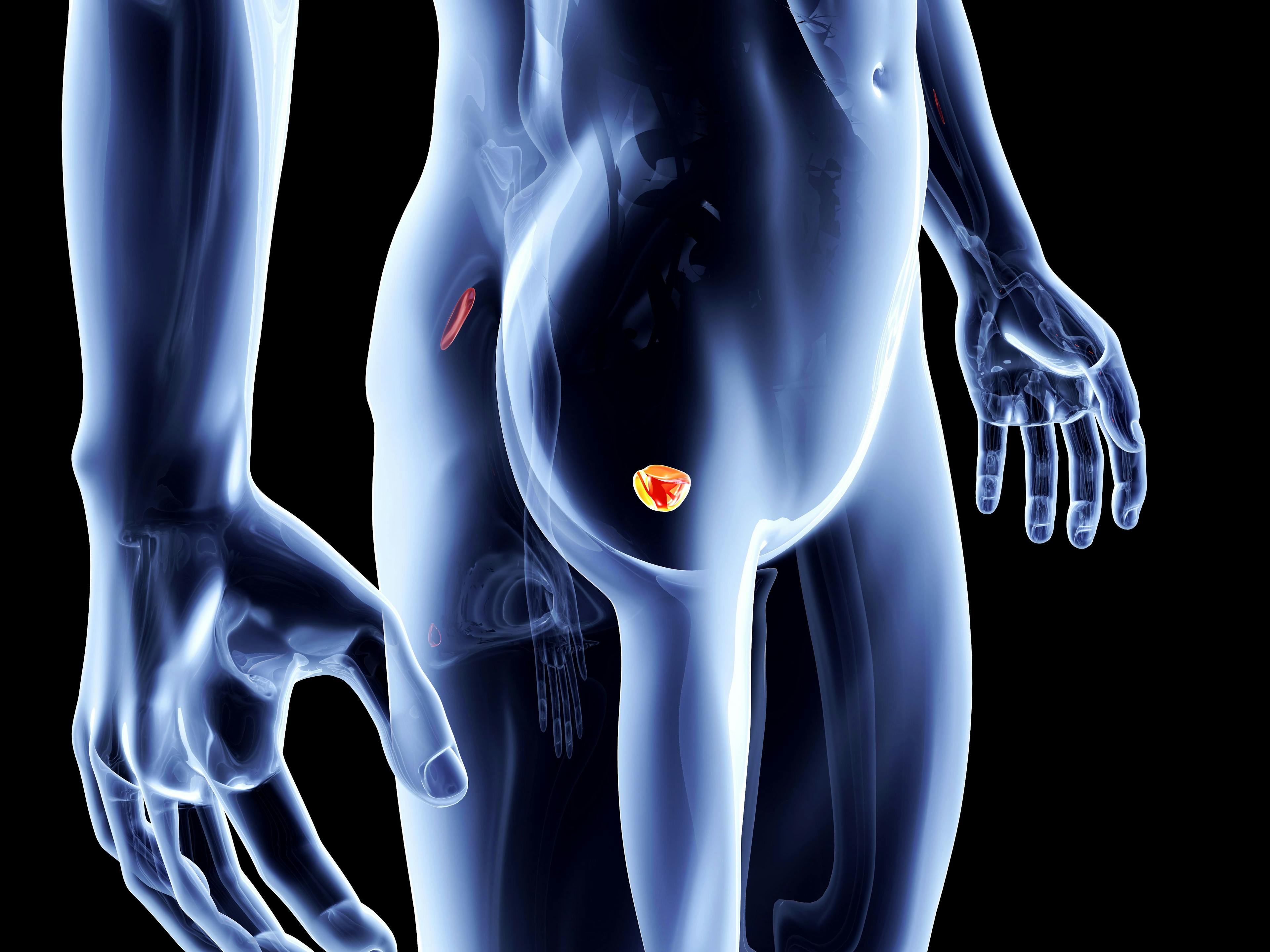 Prostate cancer treatment complications