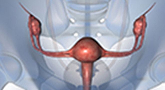 Longer Time Between Pre- And Postoperative Chemo Worsens Survival in Ovarian Cancer