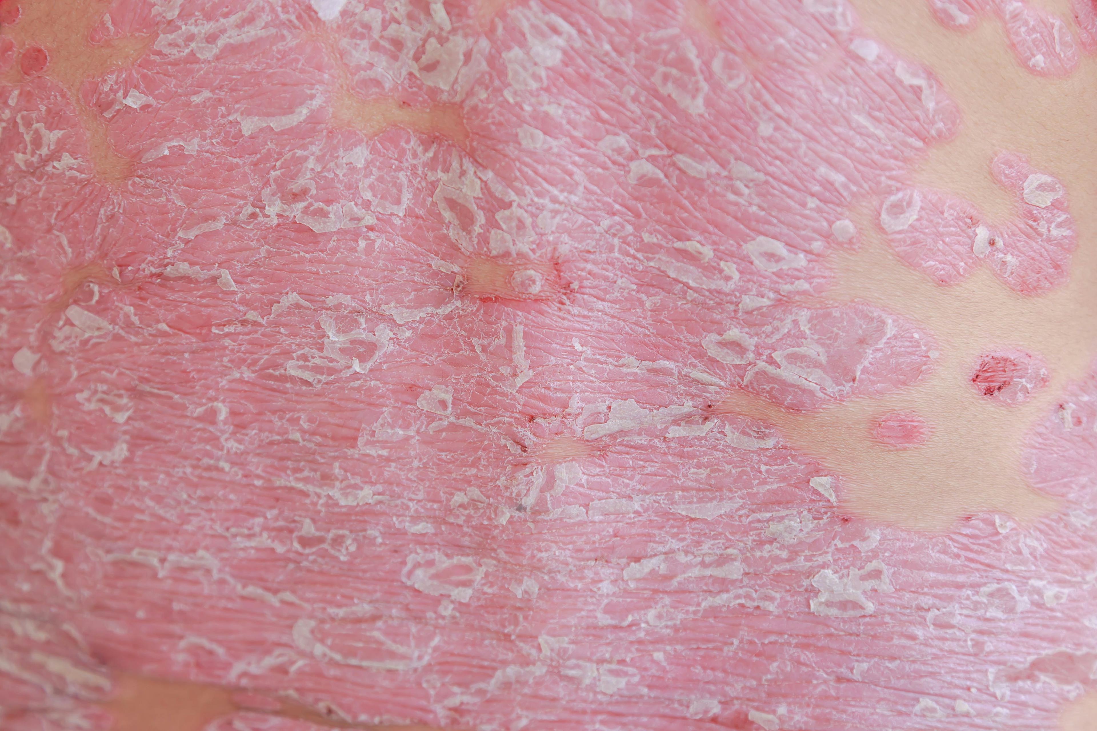 closeup of dermatitis