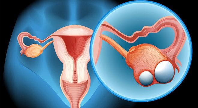 Triplet Combo Yields Durable Responses in Recurrent Epithelial Ovarian Cancer