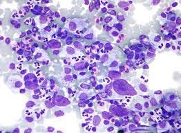 image of lymphoma cells