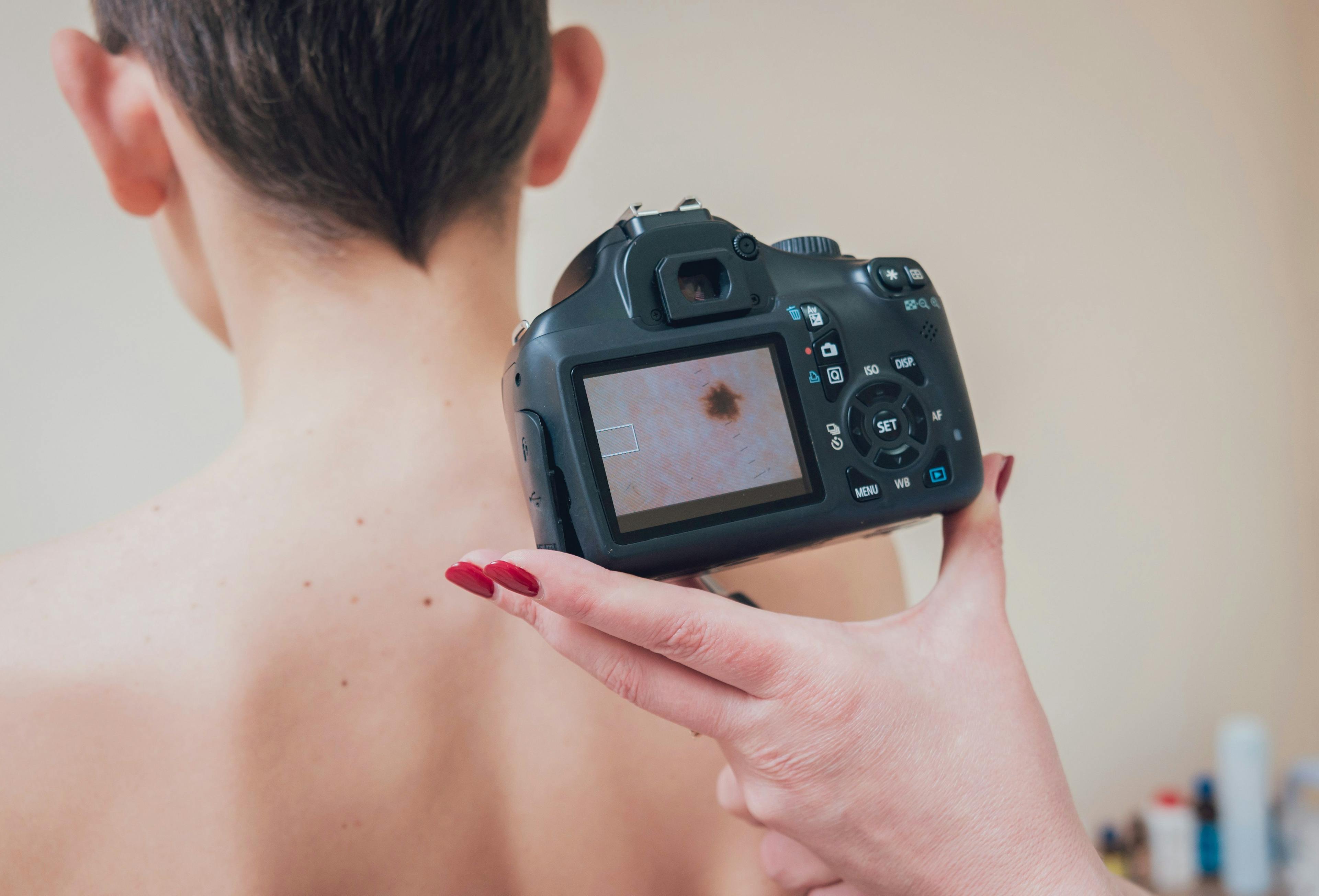 camera zooming in on a skin cancer lesion 