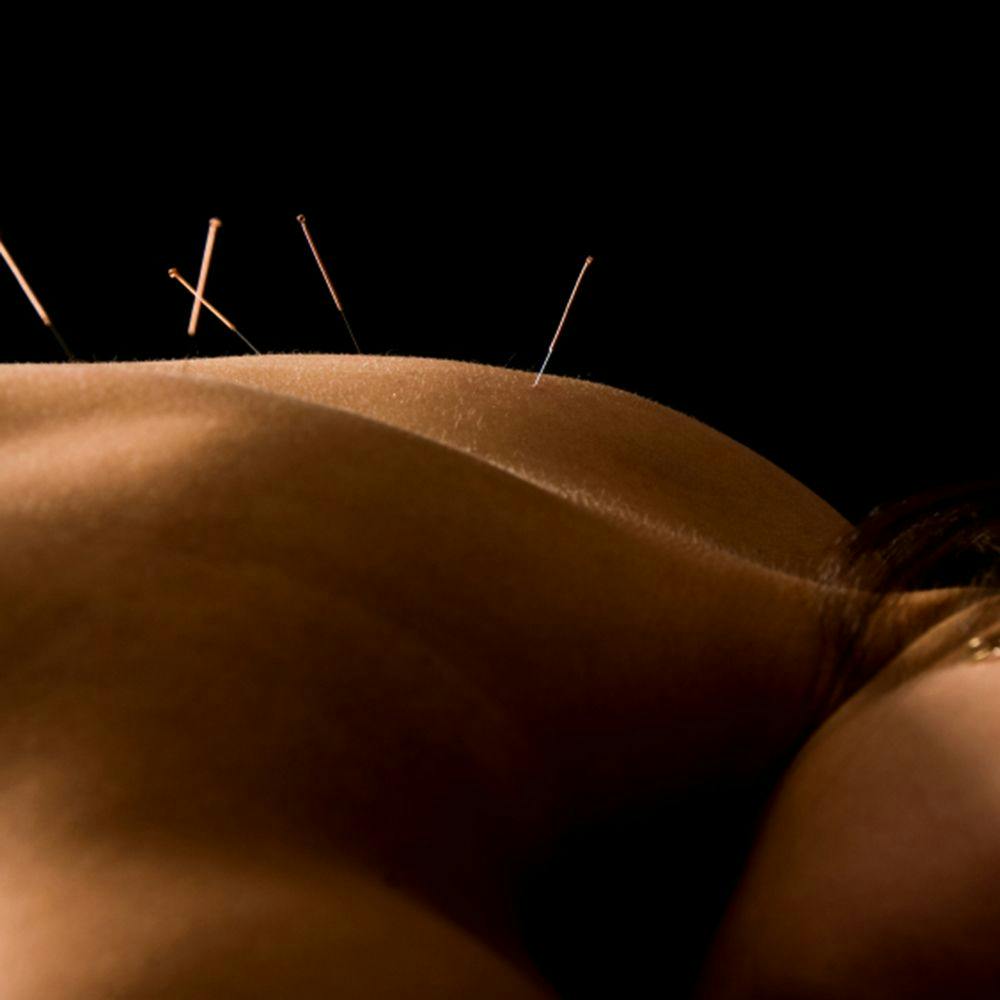 Acupuncture Reduces Symptom Burden in Patients With Multiple Myeloma