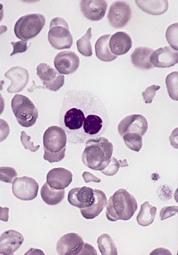 Reblozyl is a ‘Better First-Line Therapy’ for Anemia in MDS Subset
