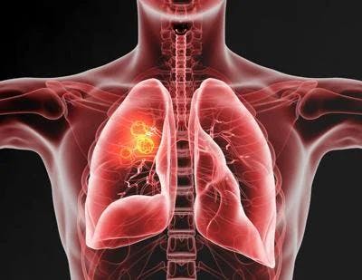 Tagrisso plus chemotherapy may improve results for NSCLC