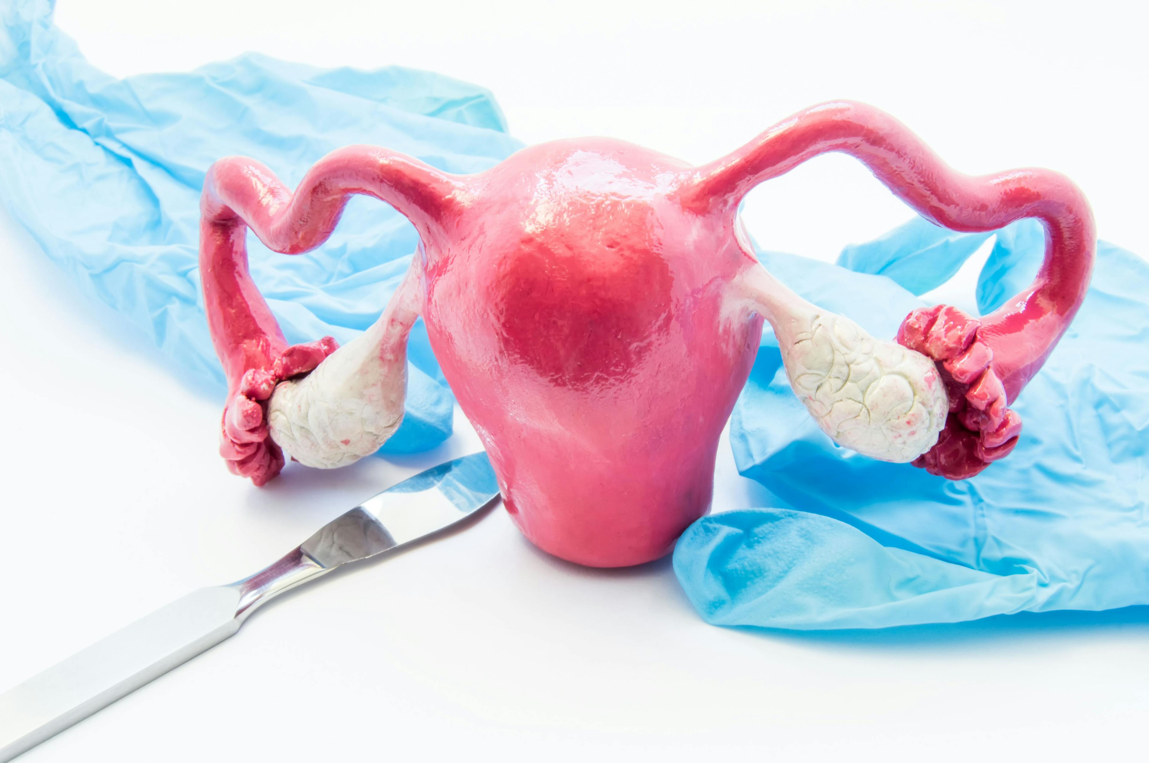 Concept of gynecology surgery. 3D model of female uterus is near scalpel and medical gloves. Surgery in gynecology and operation on uterus, ovaries or fallopian tubes such hysterectomy or myomectomy | Image credit: © shidlovski - stock.adobe.com