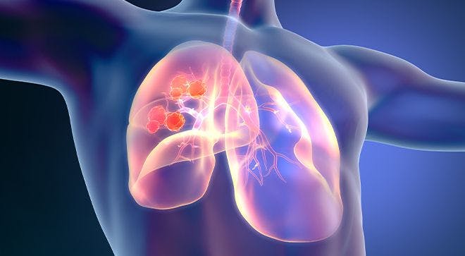 Keytruda Plus Chemoradiation Shows Promise in Locally Advanced NSCLC